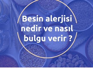 Besin alerjisi nedir ve nasıl bulgu verir ?